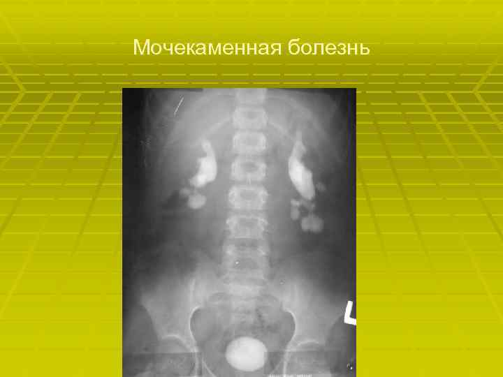 Мочекаменная болезнь 