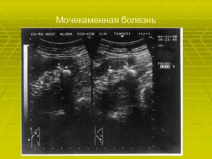 Мочекаменная болезнь 