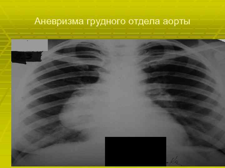 Аневризма грудного отдела аорты 
