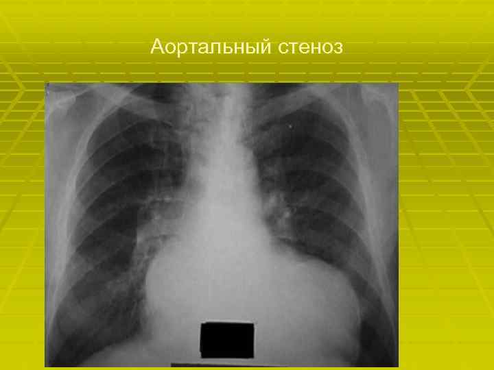 Аортальный стеноз 