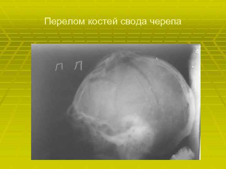 Перелом костей свода черепа 