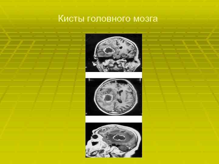 Кисты головного мозга 