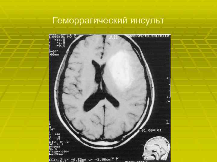 Геморрагический инсульт 