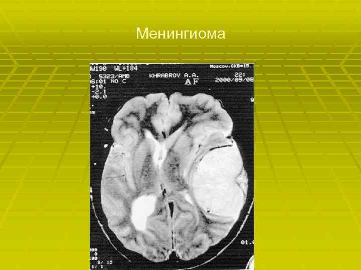 Менингиома 