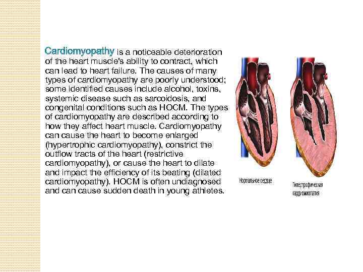 is a noticeable deterioration of the heart muscle's ability to contract, which can lead