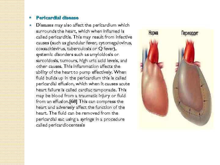  Diseases may also affect the pericardium which surrounds the heart, which when inflamed