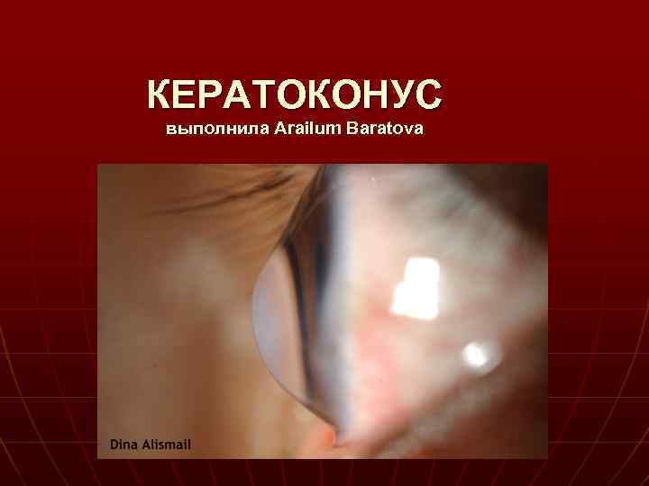 КЕРАТОКОНУС выполнила Arailum Baratova 