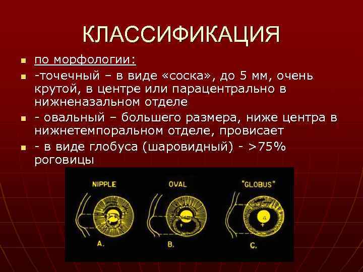 КЛАССИФИКАЦИЯ n n по морфологии: -точечный – в виде «соска» , до 5 мм,