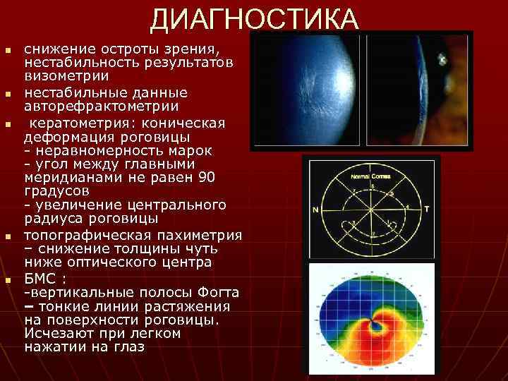 ДИАГНОСТИКА n n n снижение остроты зрения, нестабильность результатов визометрии нестабильные данные авторефрактометрии кератометрия: