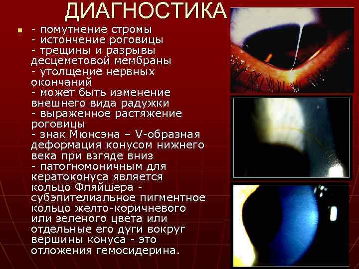 ДИАГНОСТИКА n - помутнение стромы - истончение роговицы - трещины и разрывы десцеметовой мембраны