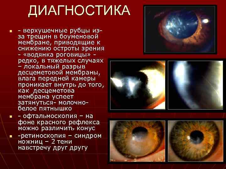 ДИАГНОСТИКА n n n - верхушечные рубцы изза трещин в боуменовой мембране, приводящие к