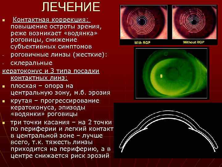 ЛЕЧЕНИЕ Контактная коррекция: повышение остроты зрения, реже возникает «водянка» роговицы, снижение субъективных симптомов роговичные