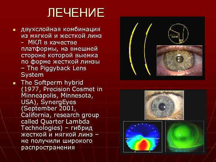 ЛЕЧЕНИЕ n n двухслойная комбинация из мягкой и жесткой линз - МКЛ в качестве