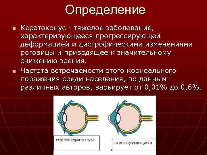 Определение n n Кератоконус - тяжелое заболевание, характеризующееся прогрессирующей деформацией и дистрофическими изменениями роговицы