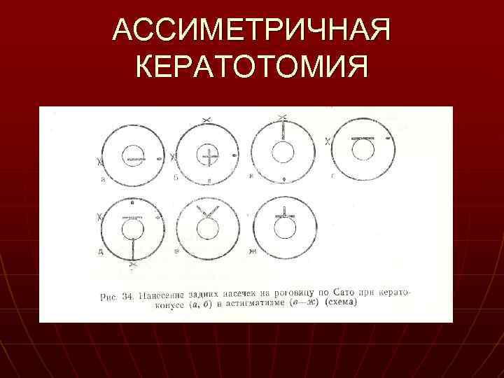 АССИМЕТРИЧНАЯ КЕРАТОТОМИЯ 