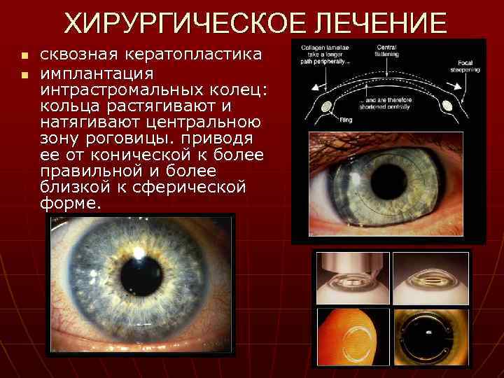 ХИРУРГИЧЕСКОЕ ЛЕЧЕНИЕ n n сквозная кератопластика имплантация интрастромальных колец: кольца растягивают и натягивают центральною