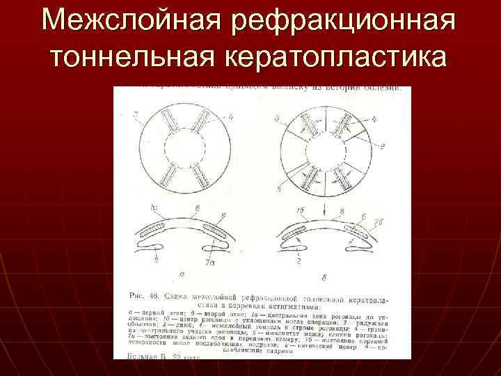 Межслойная рефракционная тоннельная кератопластика 