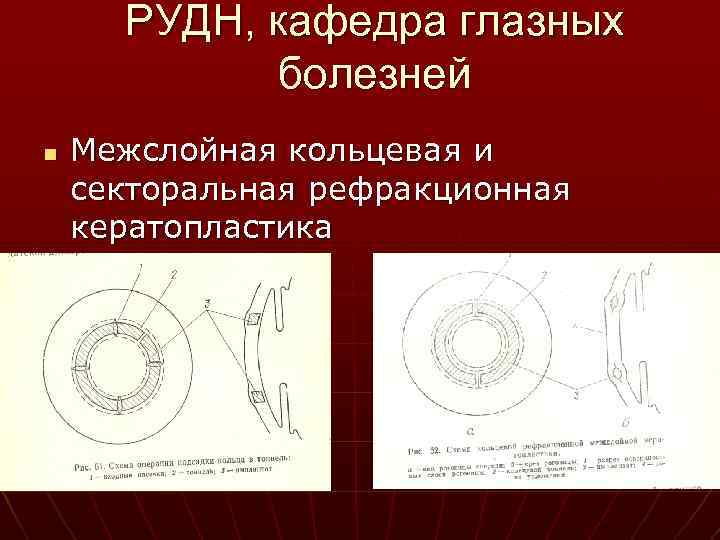 РУДН, кафедра глазных болезней n Межслойная кольцевая и секторальная рефракционная кератопластика 