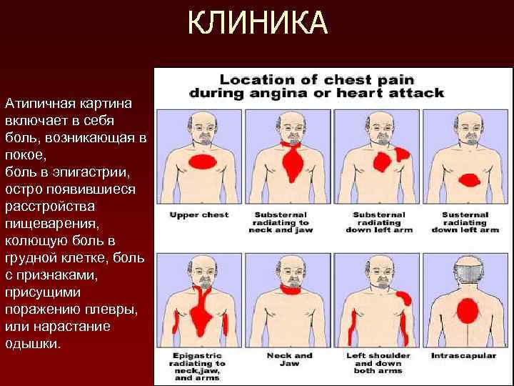 КЛИНИКА Атипичная картина включает в себя боль, возникающая в покое, боль в эпигастрии, остро