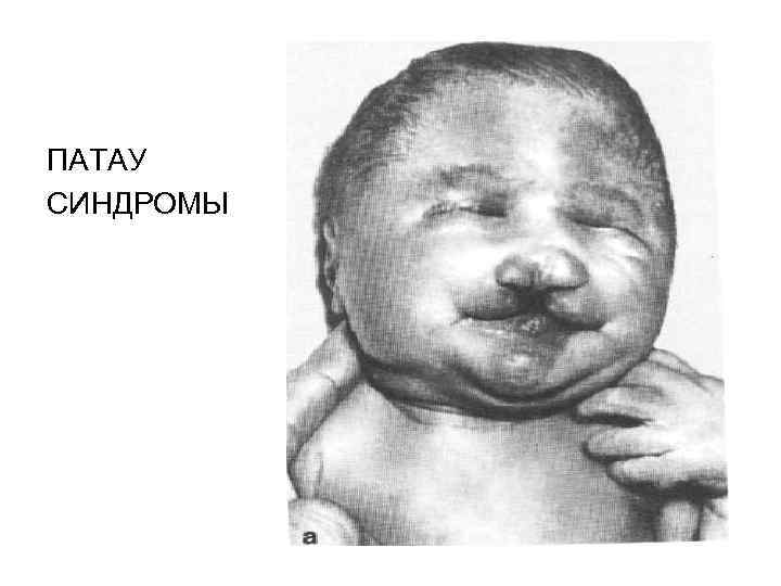 ПАТАУ СИНДРОМЫ 