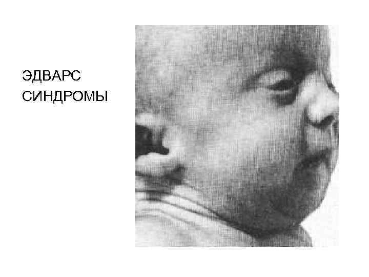 ЭДВАРС СИНДРОМЫ 