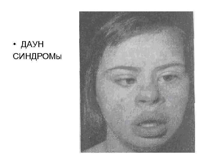  • ДАУН СИНДРОМы 