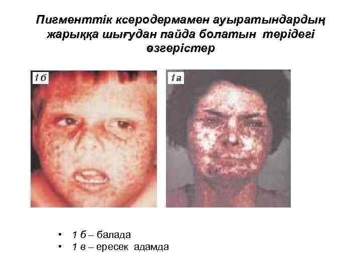 Пигменттік ксеродермамен ауыратындардың жарыққа шығудан пайда болатын терідегі өзгерістер • 1 б – балада