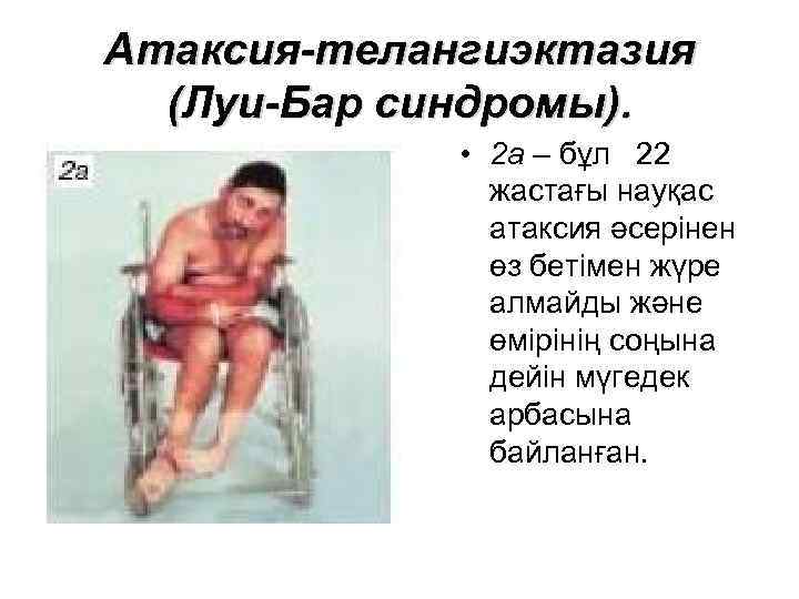 Атаксия-телангиэктазия (Луи-Бар синдромы). • 2 а – бұл 22 жастағы науқас атаксия әсерінен өз