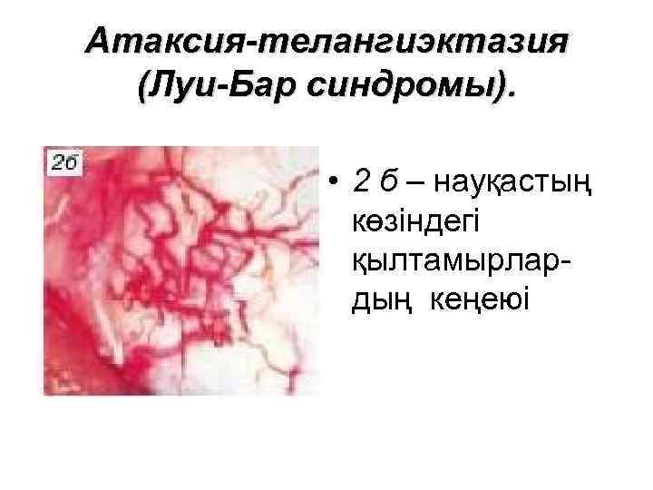 Атаксия-телангиэктазия (Луи-Бар синдромы). • 2 б – науқастың көзіндегі қылтамырлардың кеңеюі 