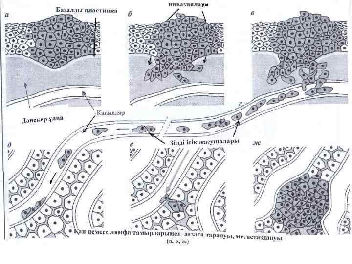 Ісік жасушаларының метастаз беруі 