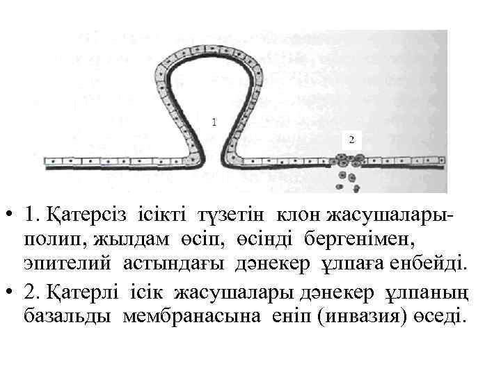  • 1. Қатерсіз ісікті түзетін клон жасушаларыполип, жылдам өсіп, өсінді бергенімен, эпителий астындағы