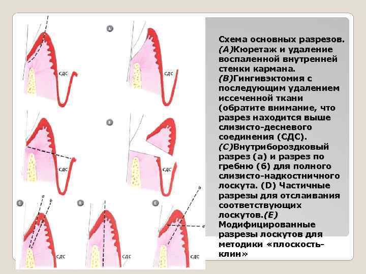 Схема основных разрезов. (А)Кюретаж и удаление воспаленной внутренней стенки кармана. (В)Гингивэктомия с последующим удалением