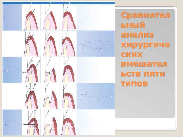 Сравнител ьный анализ хирургиче ских вмешател ьств пяти типов 