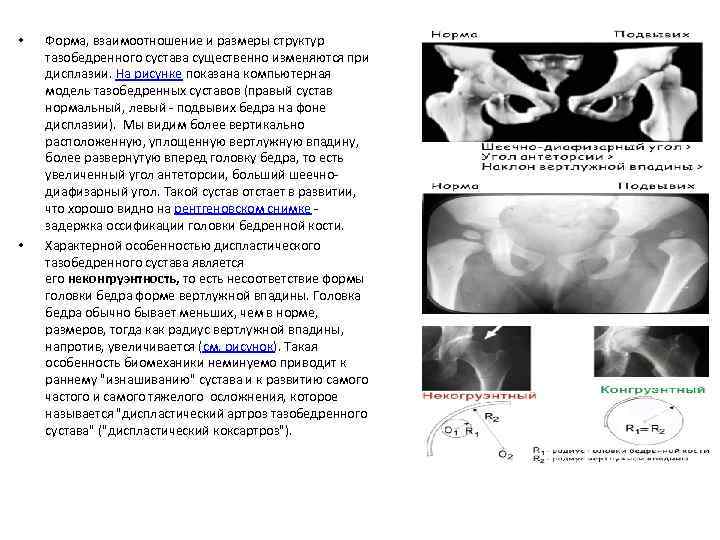  • • Форма, взаимоотношение и размеры структур тазобедренного сустава существенно изменяются при дисплазии.