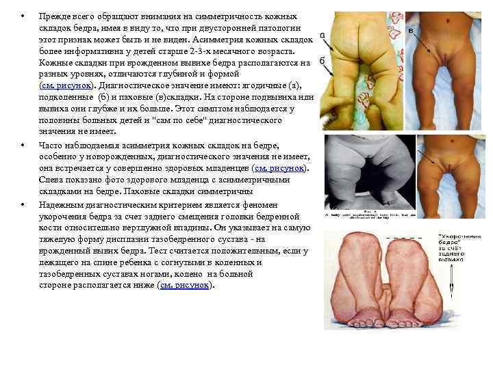  • • • Прежде всего обращают внимания на симметричность кожных складок бедра, имея