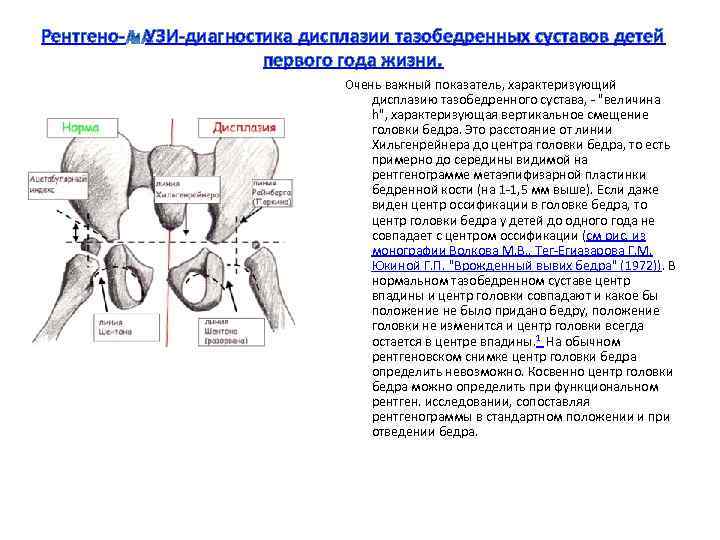 Рентгено- УЗИ-диагностика дисплазии тазобедренных суставов детей первого года жизни. Очень важный показатель, характеризующий дисплазию