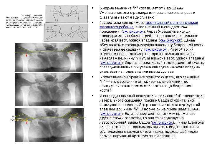  • • В норме величина "h" составляет от 9 до 12 мм. Уменьшение