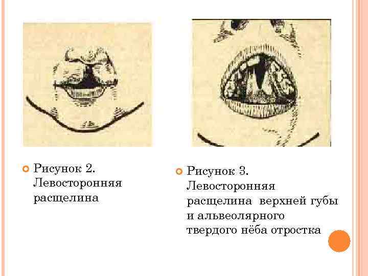  Рисунок 2. Левосторонняя расщелина Рисунок 3. Левосторонняя расщелина верхней губы и альвеолярного твердого