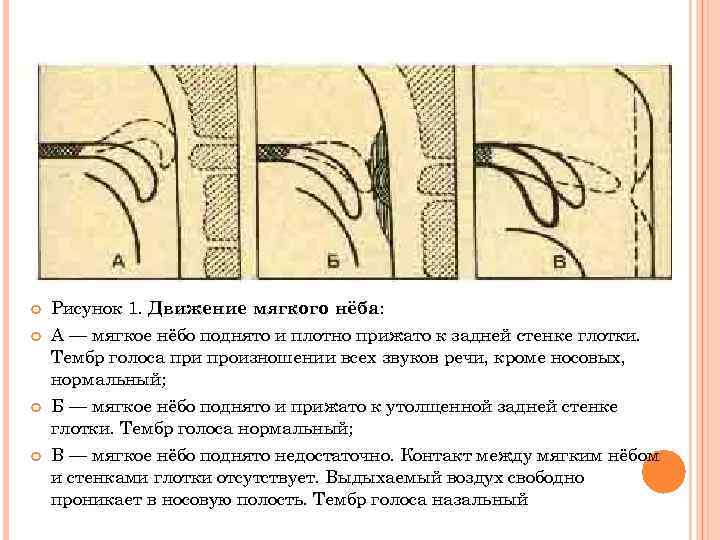  Рисунок 1. Движение мягкого нёба: А — мягкое нёбо поднято и плотно прижато