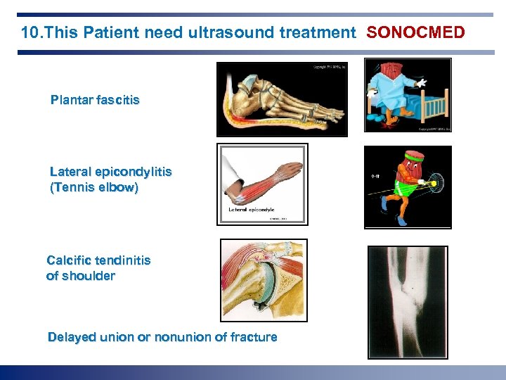 10. This Patient need ultrasound treatment SONOCMED Plantar fascitis Lateral epicondylitis (Tennis elbow) Calcific
