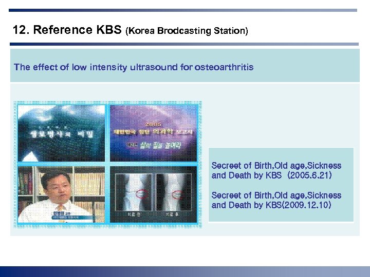 12. Reference KBS (Korea Brodcasting Station) The effect of low intensity ultrasound for osteoarthritis