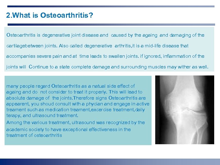 2. What is Osteoarthritis? Osteoarthritis is degenerative joint disease and caused by the againg