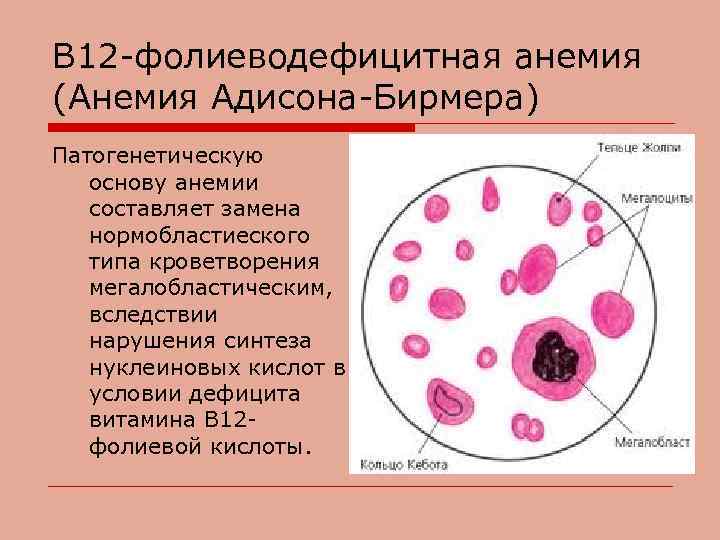 В 12 -фолиеводефицитная анемия (Анемия Адисона-Бирмера) Патогенетическую основу анемии составляет замена нормобластиеского типа кроветворения