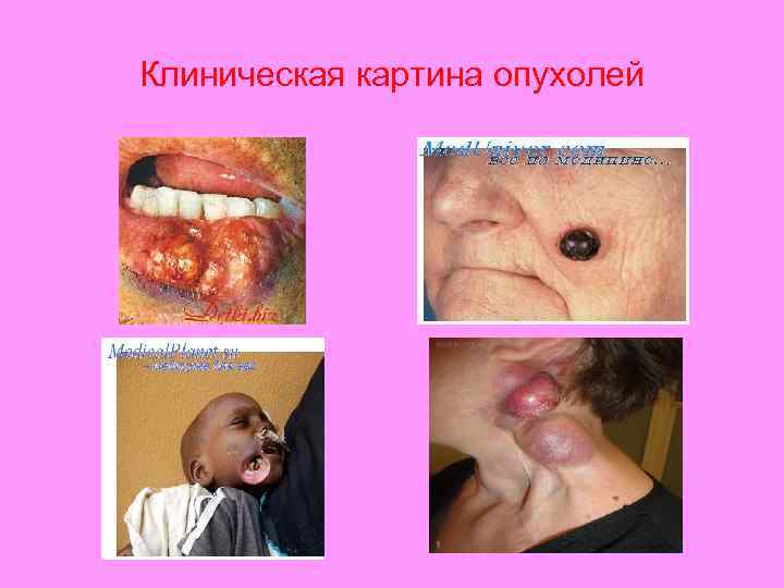 Клиническая картина опухолей 