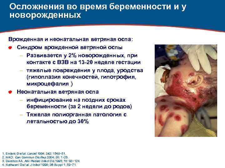 Осложнения во время беременности и у новорожденных Врожденная и неонатальная ветряная оспа: Синдром врожденной