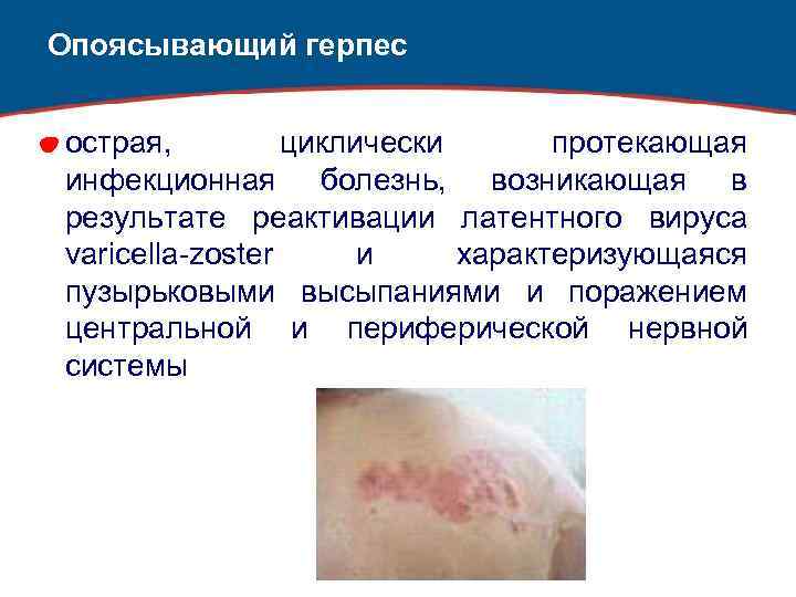 Опоясывающий герпес острая, циклически протекающая инфекционная болезнь, возникающая в результате реактивации латентного вируса varicella-zoster