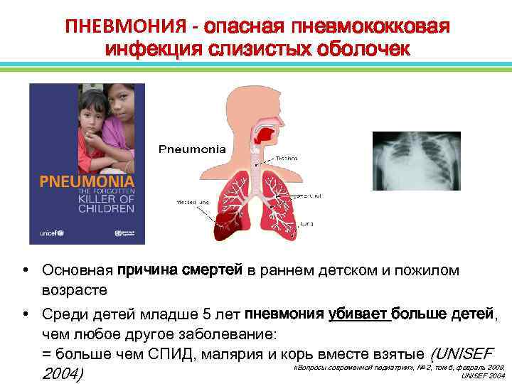ПНЕВМОНИЯ - опасная пневмококковая инфекция слизистых оболочек • Основная причина смертей в раннем детском