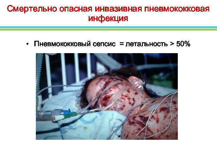 Смертельно опасная инвазивная пневмококковая инфекция • Пневмококковый сепсис = летальность > 50% 