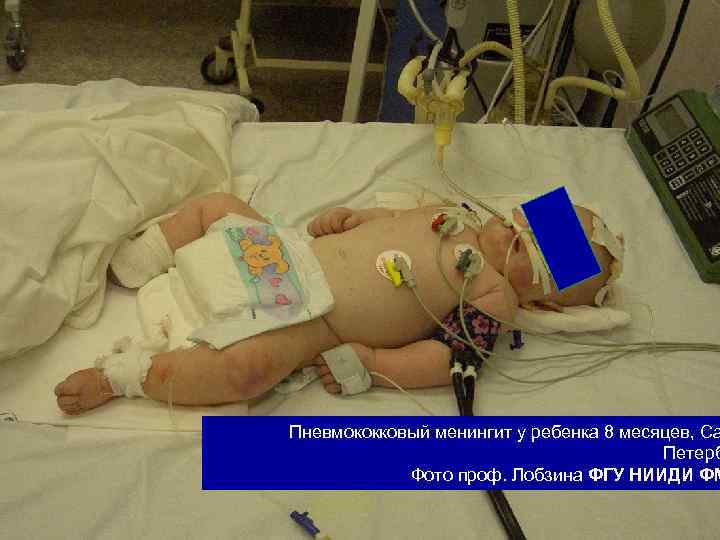 Пневмококковый менингит у ребенка 8 месяцев, Са Петерб Фото проф. Лобзина ФГУ НИИДИ ФМ