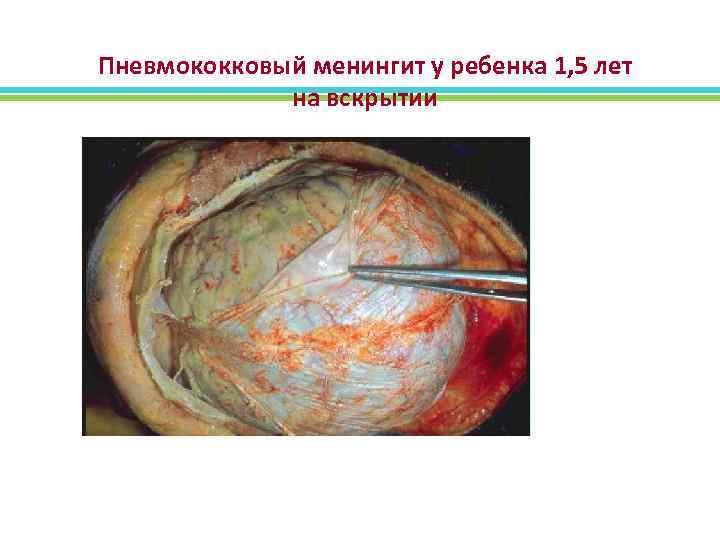 Пневмококковый менингит у ребенка 1, 5 лет на вскрытии 